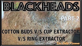 OLD BLACKHEAD REMOVAL WITH COTTON BUDS vs EXTRACTORS PART2 by DRLALIT KASANA [upl. by Nylirehc]