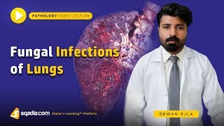 Fungal Infections of Lungs  Actinomycosis Histoplasmosis Coccidioidomycosis  Introduction [upl. by Feldt]