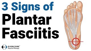 Plantar Fasciitis 3 signs you may have plantar fasciitis [upl. by Turne747]