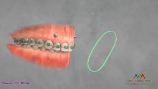 Orthodontic Treatment for Gummy Smile  TAD and Elastics [upl. by Ardnuahs552]