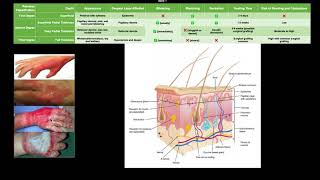 Classifying Burns EXPLAINED [upl. by Chari]