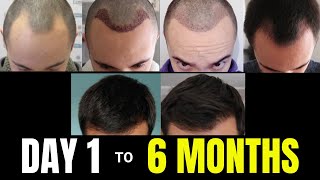 From DAY 1 to 6 MONTHS  Hair Transplant UPDATE Comparison Video [upl. by Susy4]