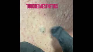 Episode 2 ingrown hair extractions [upl. by Eleanora]