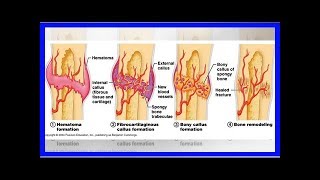 Comment guérir dune fracture [upl. by Notnel]