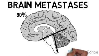 Brain Metastases [upl. by Ahseek]