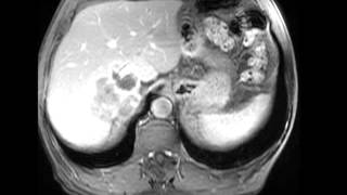 Retroperitoneal Liposarcoma [upl. by Antonino536]