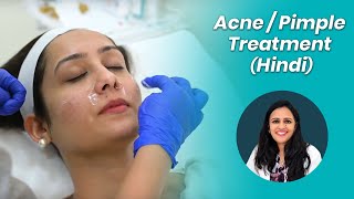 Acne Treatment Hindi  पिम्पल्स को कैसे रोके [upl. by Bonilla919]