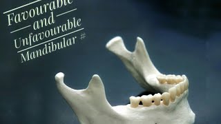 Mandibular Fractures  Favourable and Unfavourable [upl. by Marler877]