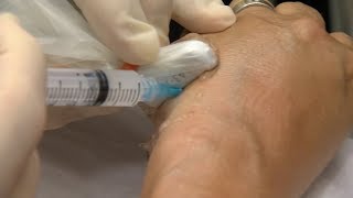 Are Cortisone Injections Safe What Are The Side Effects [upl. by Gothar]