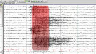 EEG in Juvenile Myoclonic Epilepsy [upl. by Ettore]