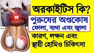 অণ্ডথলি ফোলা ব্যথা জ্বালা অরকাইটিস Orchitis অণ্ডকোষের প্রদাহ কারণ লক্ষণ চিকিৎসা [upl. by Eytteb]