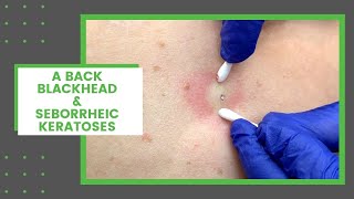 A Back Blackhead amp Seborrheic Keratoses  Dr Derm [upl. by Isiad]