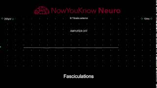 EMG Fasciculations video 2 [upl. by Oatis]