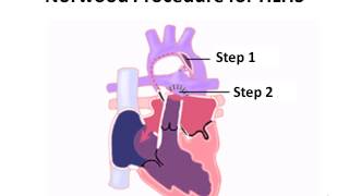 Norwood Procedure for Hypoplastic Left Heart Syndrome [upl. by Ermin]