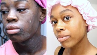 HOW I GOT RID OF DARK SPOTS BRIGHTEN DULL SKIN  HYPERPIGMENTATION [upl. by Anallese]