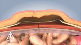 Ventral Hernia Repair  3D Medical Animation [upl. by Rhines587]