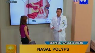 Good Morning Kuya What is Nasal Polyps [upl. by Lady]