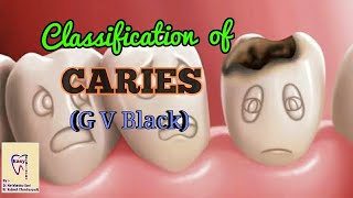 Dental Caries  Classification of dental caries  GV Black Classification [upl. by Yalonda959]