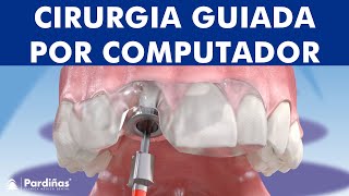 Cirurgia guiada por computador para a colocação de implante dentário © [upl. by Kisor]