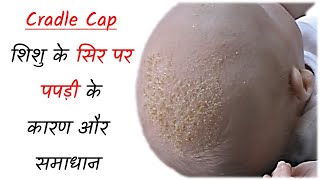 नवजात शिशु के सिर पर पपड़ी के कारण और समाधान  Cradle Cap Symptoms Reason amp Solutions in Hindi [upl. by Larrej77]