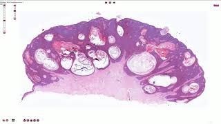 Seborrheic Keratosis Including Variants  Histopathology [upl. by Ardnwahsal666]