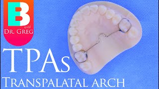 Braces TPA Transpalatal Arch [upl. by Enortna408]