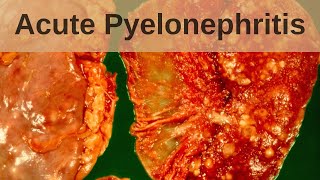 Acute pyelonephritis  Pathology mini tutorial [upl. by Anirbaz]