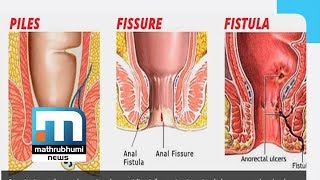 Piles Symptoms Causes And Treatment Dr2PM [upl. by Anigger]