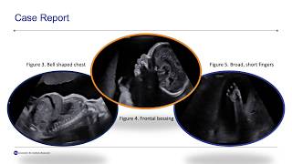 Thanatophoric Skeletal Dysplasia A Case Report and Review of Literature [upl. by Taggart]