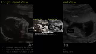 Anterior Placenta Position Ultrasound  Fetal USG  Pregnancy Sonography  Dr Sams Imaging shorts [upl. by Eannej942]