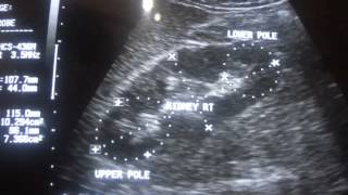 ULTRASOUND PYELONEPHRITIS acute part 1 [upl. by Atterys228]