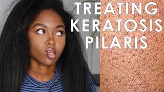 TREATING KERATOSIS PILARIS  3 EASY STEPS [upl. by Yenots]