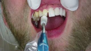 Veneers Dental Procedure at Cosmetic Dental Associates in San Antonio TX [upl. by Aisatna]