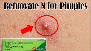 How to use Betnovate N for pimples  Remove pimples overnight remedy [upl. by Meeks]