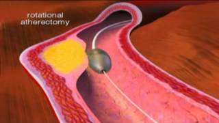 Transradial Femoral Artery Atherectomy and Angioplasty [upl. by Enilec]