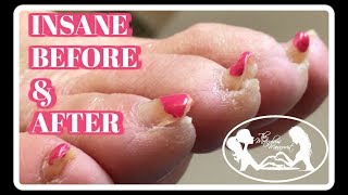 Pedicure Tutorial Elderly Thick Toenails Growing Up Transformation [upl. by Bartlet975]