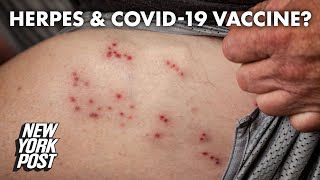 Herpes infection possibly linked to COVID19 vaccine  New York Post [upl. by Ahsiele]