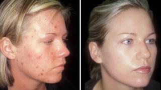 HOW TO CURE ACNE  CLEAR SKIN IN ONE WEEK [upl. by Ecyal733]