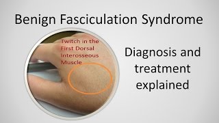 Benign Fasciculation Syndrome Causes and Treatment [upl. by Eustacia]