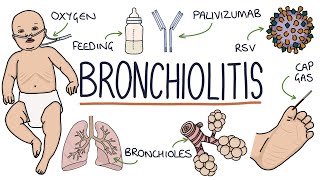 Pneumonia Imaging [upl. by Akinwahs191]