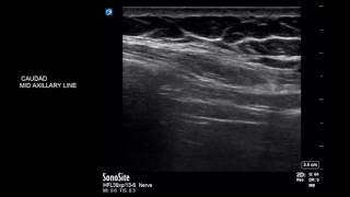 Diaphragmatic scanning using USG  ABCDE technique [upl. by Doane]