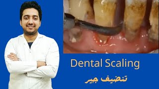 Tartar  Plaque And Calculus Removal From Lower Front Teeth  Dental Scaling On Lower Teeth  Part1 [upl. by Vilberg426]