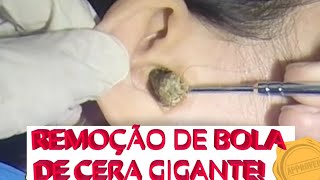 Remoção De Cera De Ouvido GIGANTE Giant Wax Removal OMG [upl. by Sair]