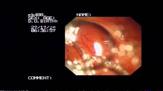 Enterobius Vermicularis Colonoscopy [upl. by Mcmullan]