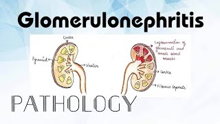 Glomerulonephritis Pathology [upl. by Pasahow]