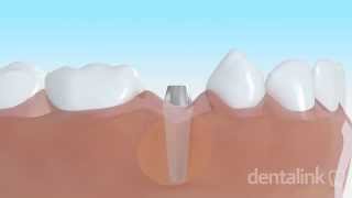 IMPLANTE DENTAL óseo integrado  Video 3D paso a paso [upl. by Blader]