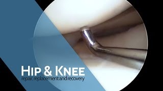 Arthroscopic Meniscus Repair [upl. by Dranyar]