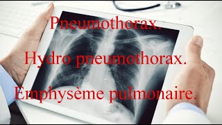 Pneumothorax  Hydro pneumothorax  Emphysème pulmonaire [upl. by Zetrauq]