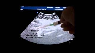 UltrasoundGuided Injection of the Piriformis Muscle [upl. by Pontone]