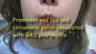 Strep Throat and Scarlet Fever [upl. by Blasien]